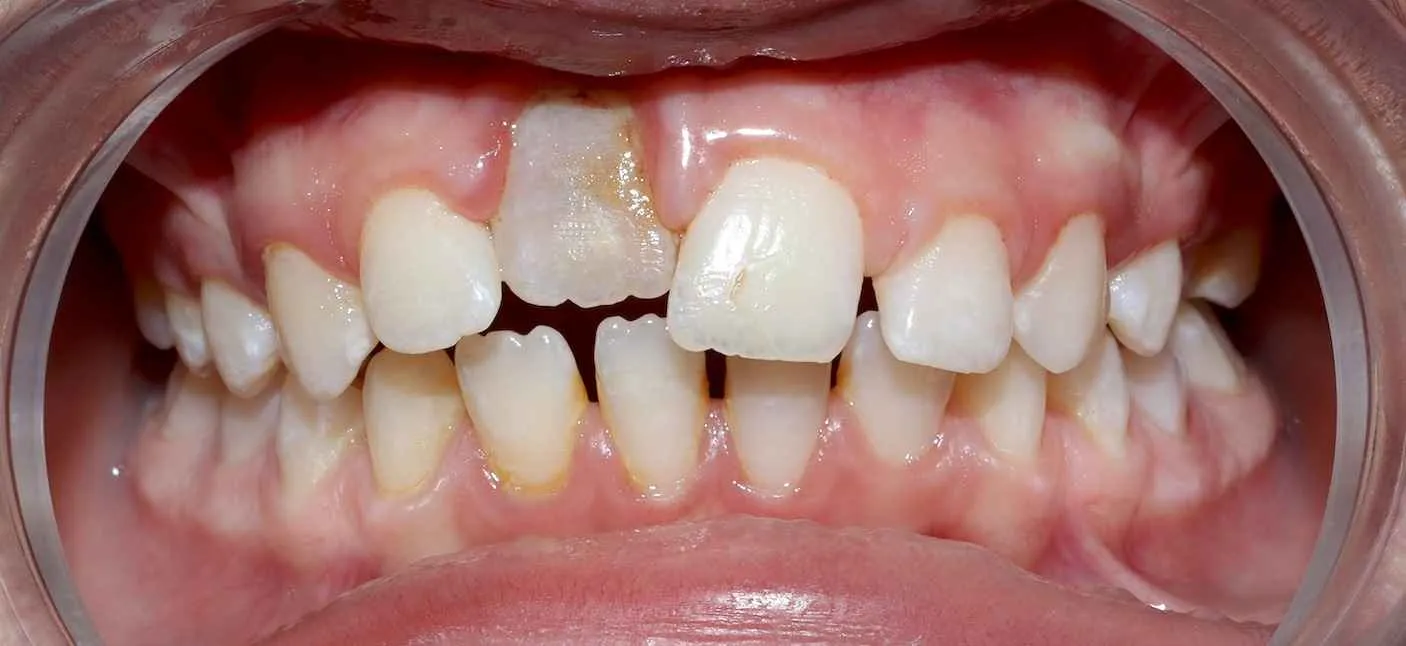 Pedodonti, çocuk diş hekimliği alanıdır ve çocuklarda meydana gelen dental travmalar bu alanın önemli bir konusudur. Düşme, çarpma, spor kazaları gibi nedenlerle dişlerde oluşan kırıklar, yer değiştirmeler veya tamamen çıkmalar gibi durumlar travma kapsamındadır. Bu tür durumlarda, dişin durumuna göre uygulanan müdahaleler, dişi kurtarmak ve ağız sağlığını korumak amacıyla yapılır. Tedavi; süt dişleri ya da daimi dişlerde farklı yöntemlerle uygulanabilir.