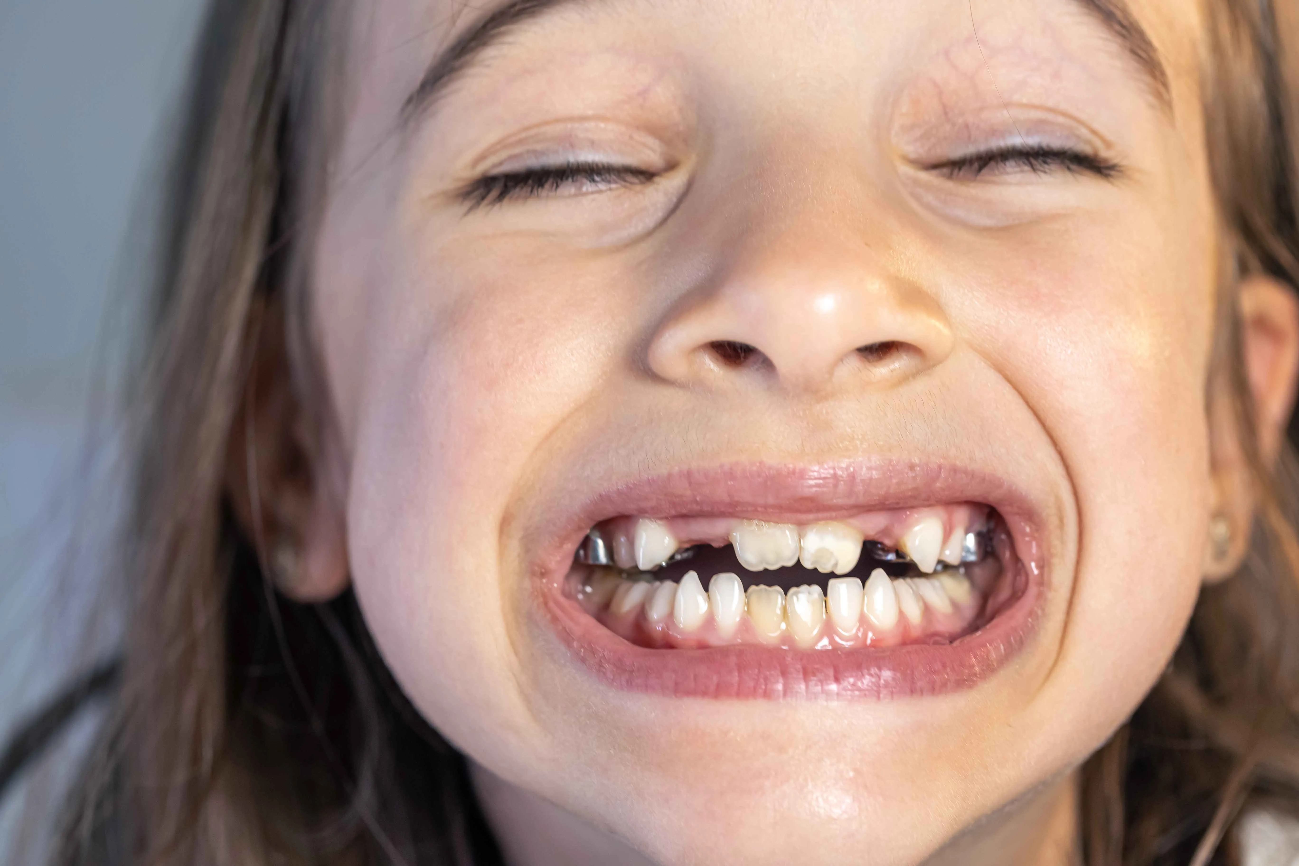 Yapısal ya da genetik bozukluğu olan dişler; mine, dentin veya diş yapısının doğuştan gelen bir anormalliğe sahip olması durumudur. Bu bozukluklar; dişlerde renk değişimi, hassasiyet, çabuk kırılma, eksik diş gelişimi gibi şekillerde görülebilir. Pedodonti uzmanları tarafından uygulanan tedaviler, çocuğun hem estetik görünümünü hem de çiğneme fonksiyonunu yeniden kazandırmayı hedefler.