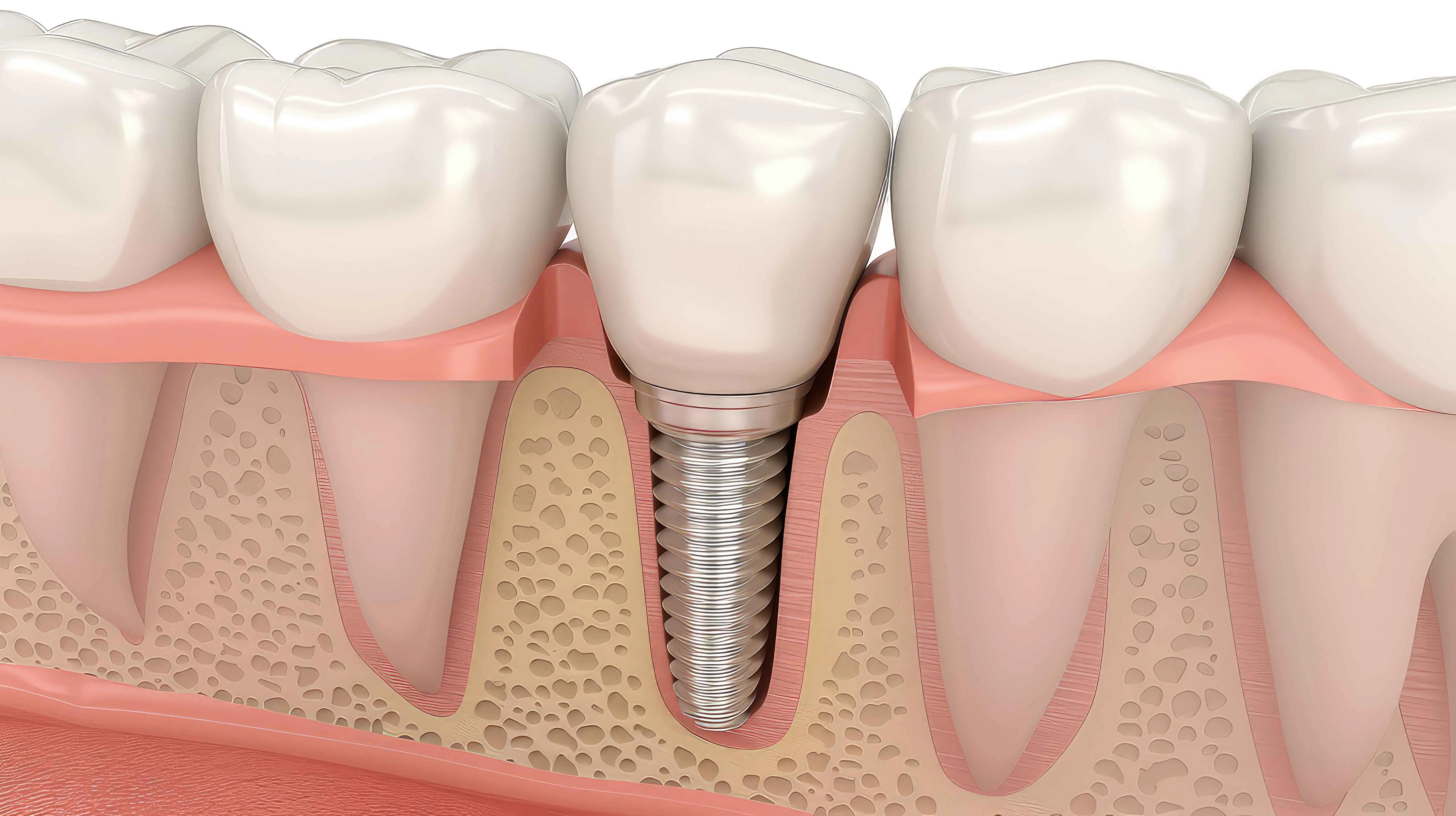 İmplant cerrahisi, kaybedilen dişlerin yerine titanyumdan üretilmiş yapay köklerin (implantların) çene kemiğine yerleştirilmesi işlemidir. Bu implantlar, üzerine porselen veya zirkonyum kaplamalar yerleştirilerek doğal diş görünümüne ve işlevine sahip sabit dişler elde edilmesini sağlar. Modern diş hekimliğinde en kalıcı ve estetik çözüm olarak kabul edilir.