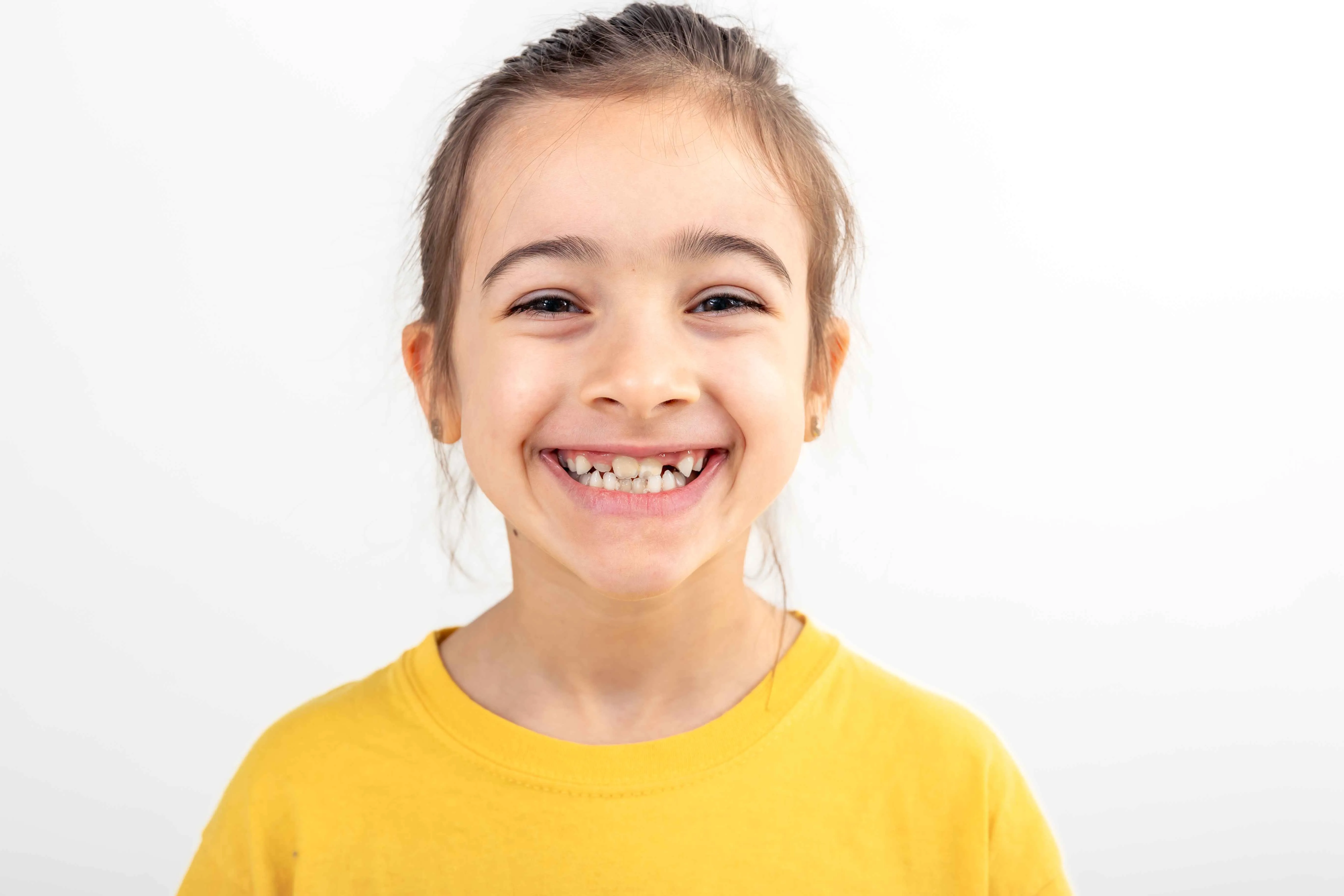 Erken yaş ortodontik tedavi, çocuklarda çene ve diş gelişiminin aktif olduğu dönemlerde uygulanan koruyucu ve yönlendirici bir ortodontik müdahaledir. Genellikle 6–10 yaş arasındaki çocuklarda, süt dişlerinin yerini daimi dişlerin almaya başladığı karma dişlenme döneminde uygulanır. Bu dönemde yapılan tedaviler, ileride oluşabilecek ciddi ortodontik problemleri önleyebilir veya etkilerini azaltabilir.
