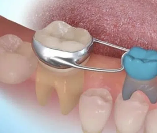 süt dişi çekimi ve yer tutucu tedavisi