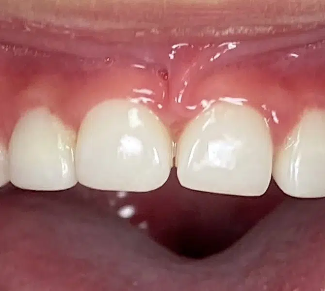 çocuklarda zirkonyum diş kaplama izmir