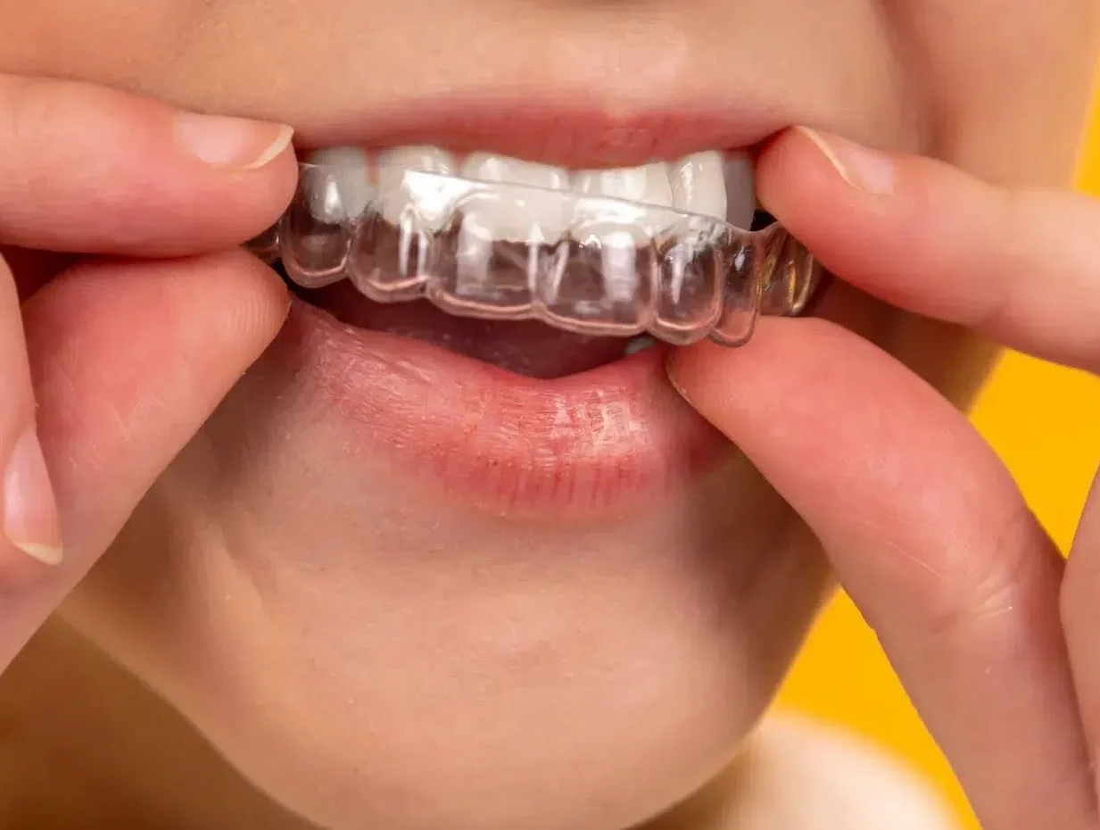 Erken ortodonti tedavisi için şeffaf plak uygulaması