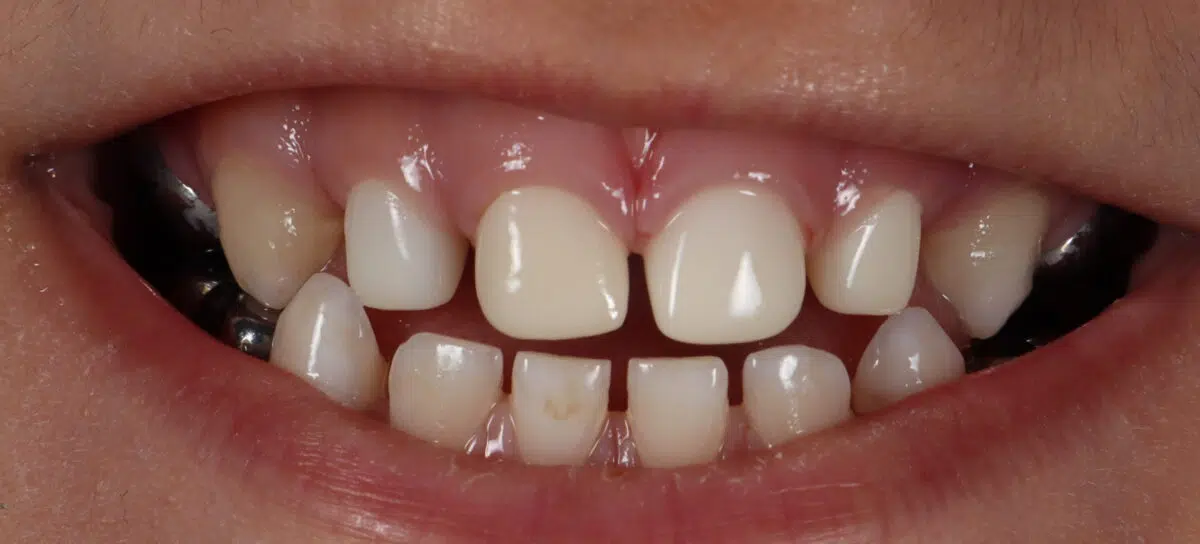 Çocuklarda zirkonyum kaplama