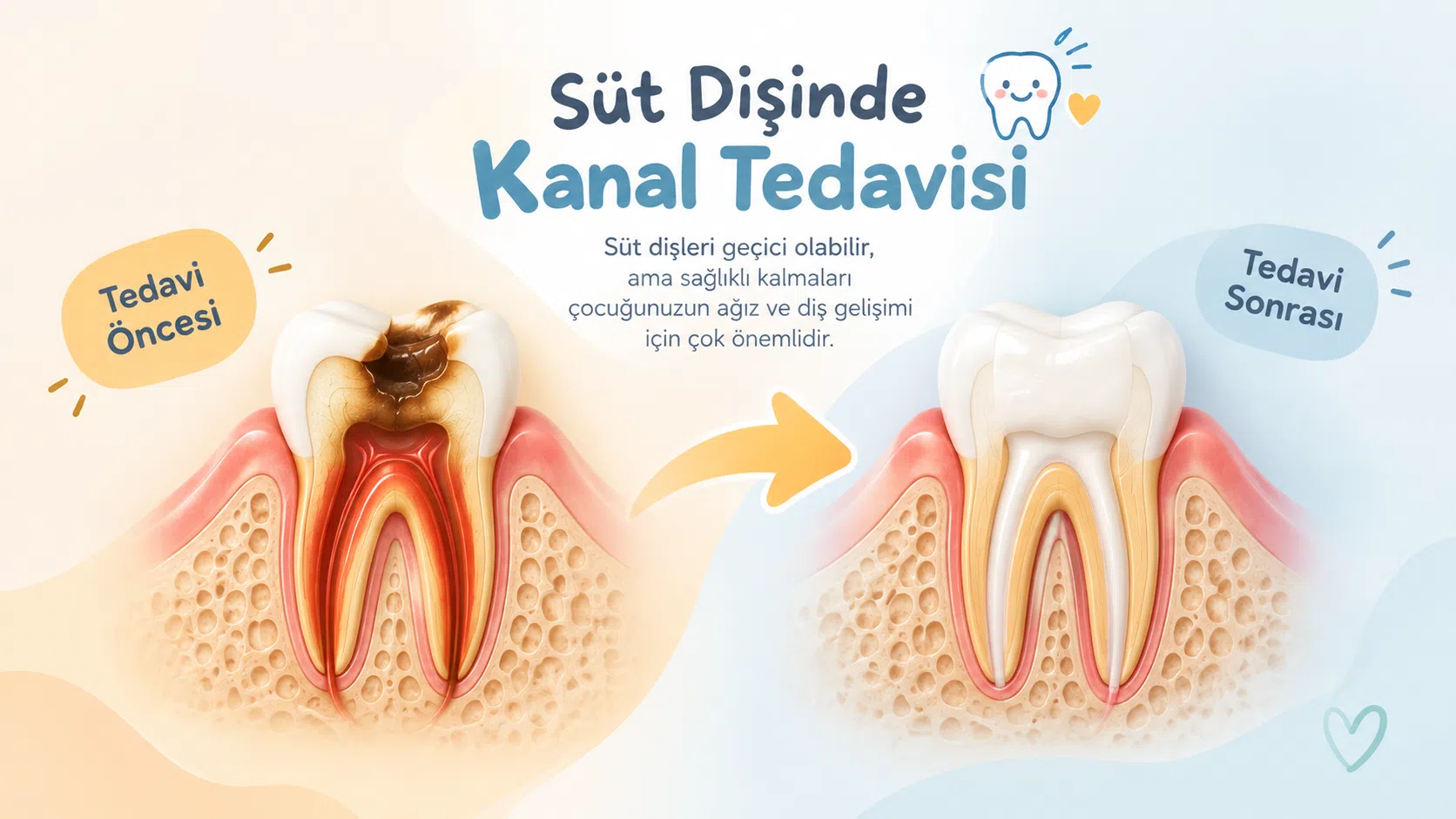 süt dişi kanal tedavisi